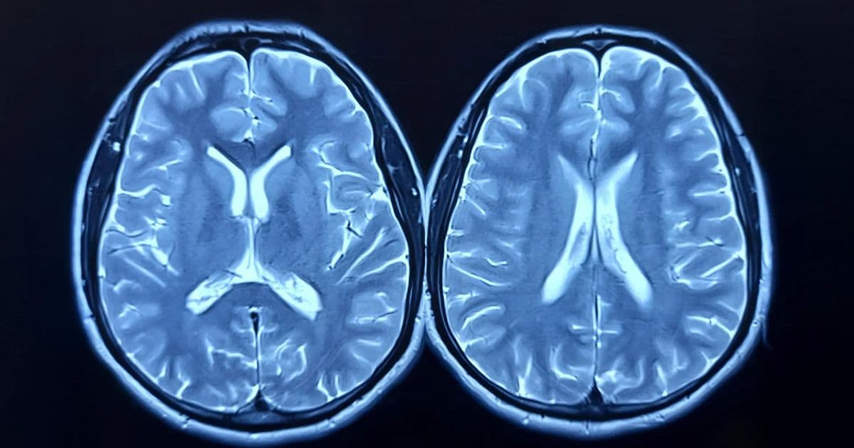 MRI Scans Show Exercise Can Make the Brain Look Younger