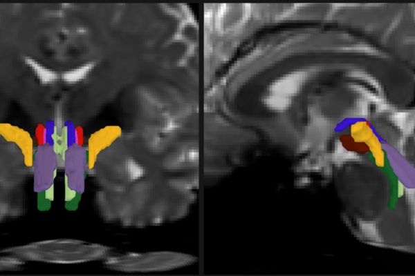 AI Breakthrough Enables First Detailed Mapping of Brainstem White Matter Pathways
