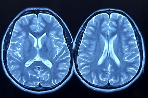 MRI Scans Show Exercise Can Make the Brain Look Younger