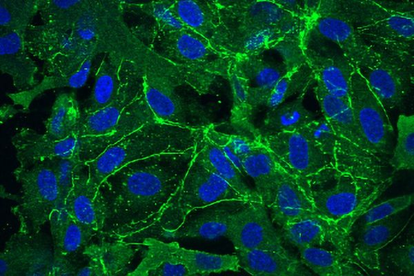 MIT researchers trace Rett syndrome's vascular defects to microRNA overexpression