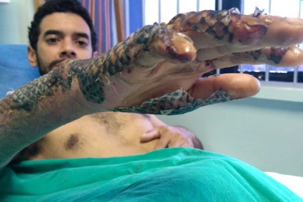 Tilapia Skin Bandages: An Ingenious Burn Treatment Emerges From Resource Constraints